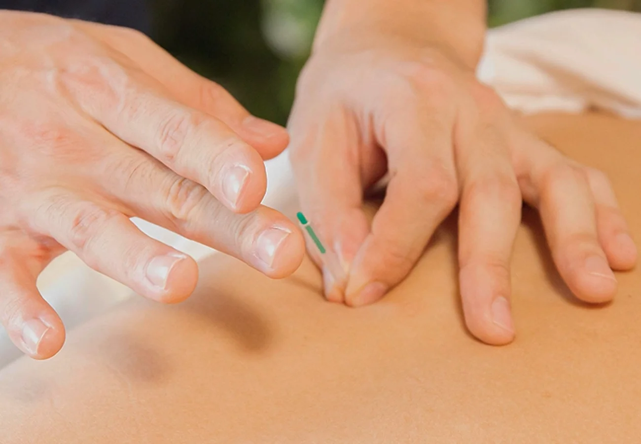 Dry needling bij Fysiotherapie Eemnes